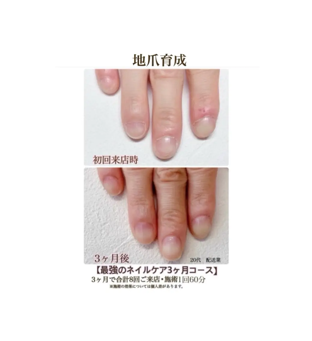 最強のネイルケア✨地爪のお悩みにさようなら❣️地爪育成コース8回3ヶ月¥67.200▶︎¥47.000モニター募集中‼️の写真