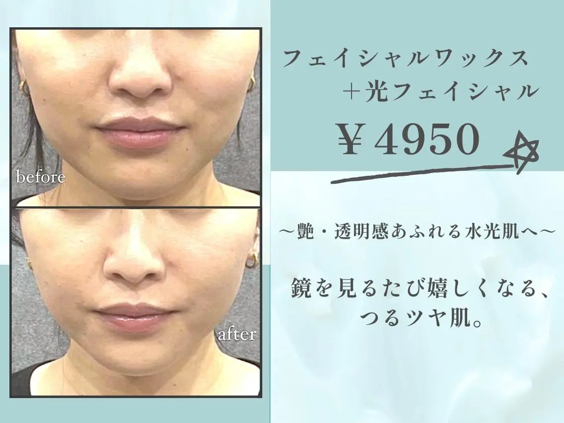 フェイシャルワックス＋光フェイシャル ￥4,950の写真