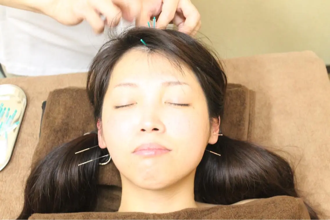 【新メニュー】ICCO美容鍼の写真
