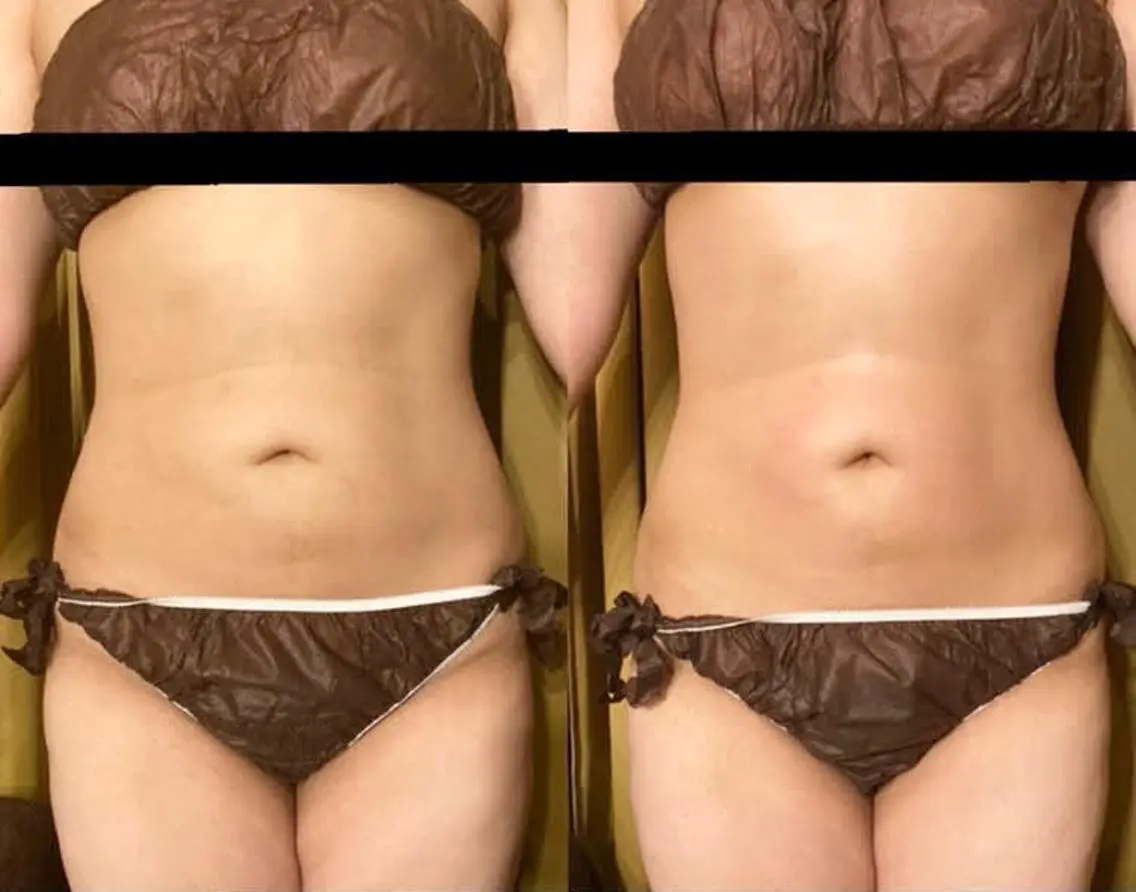 【痩身】当店人気No.1マシン🏅サーモシェイプDeep60分🔥スッキリ美Bodyへの写真