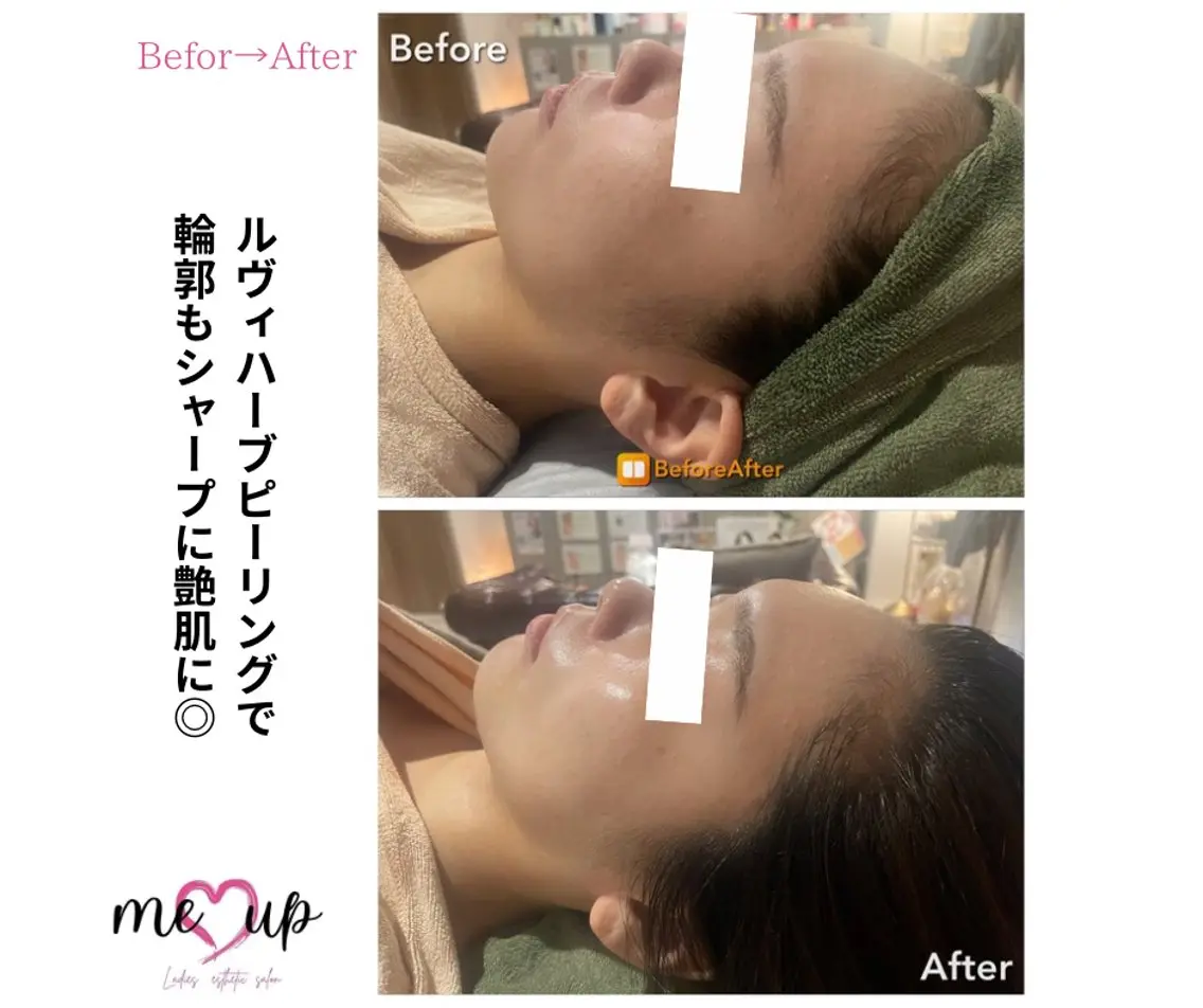 エステ Meupニキビ専門店 背中/ハーブ/肌管理のその他イメージ