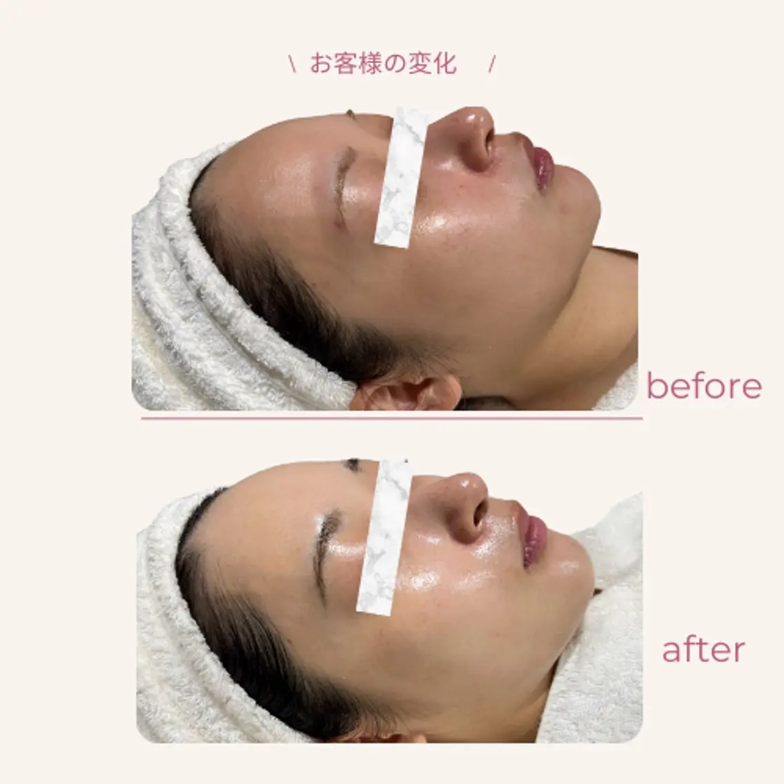 🩵日付限定🩵ラミピール◇次世代ピーリング|剥離なし｜ララピール｜毛穴｜くすみ｜ニキビ｜シワの写真