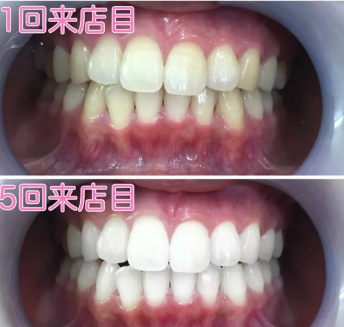 ✨ご新規様限定✨8分照射×2回【¥2000】🦷❣️の写真