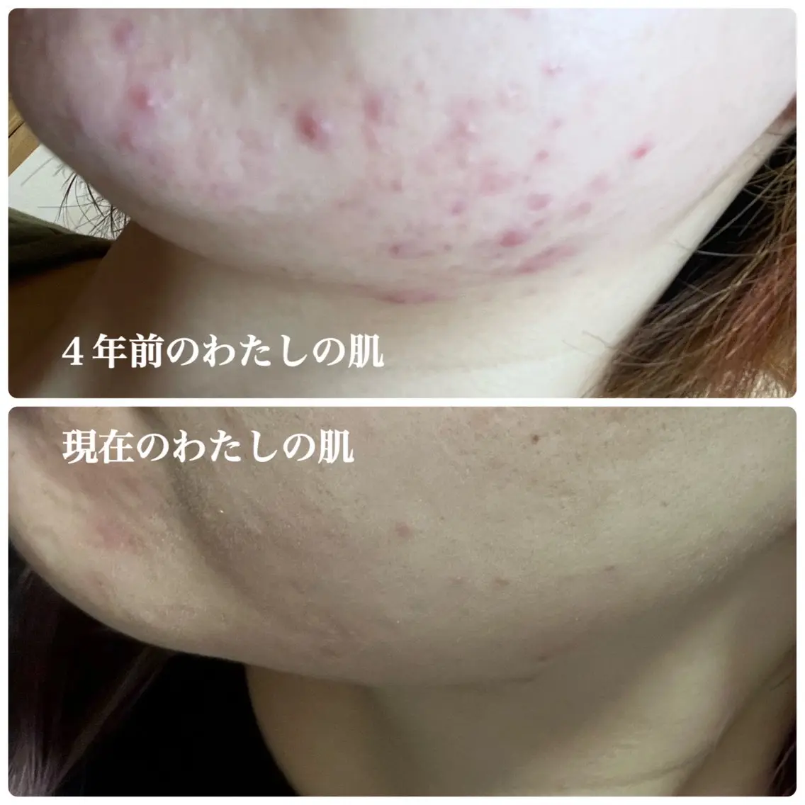 【ニキビ肌の方限定】【無料カウンセリング】【ニキビに効く美容液サンプルプレゼント🎁】の写真
