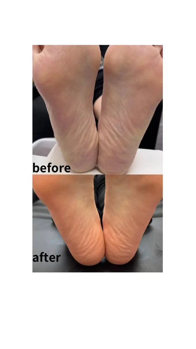 サンダルの時期にオススメフットケア👣❣️の写真