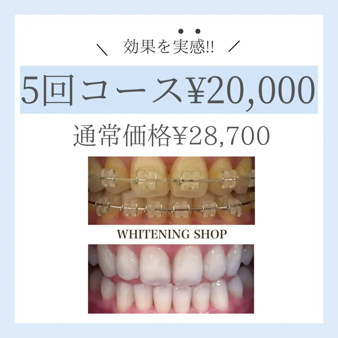 【効果を実感したい方◎】セルフホワイトニング40分×5回 (￥4000/回)¥28700→￥20000の写真