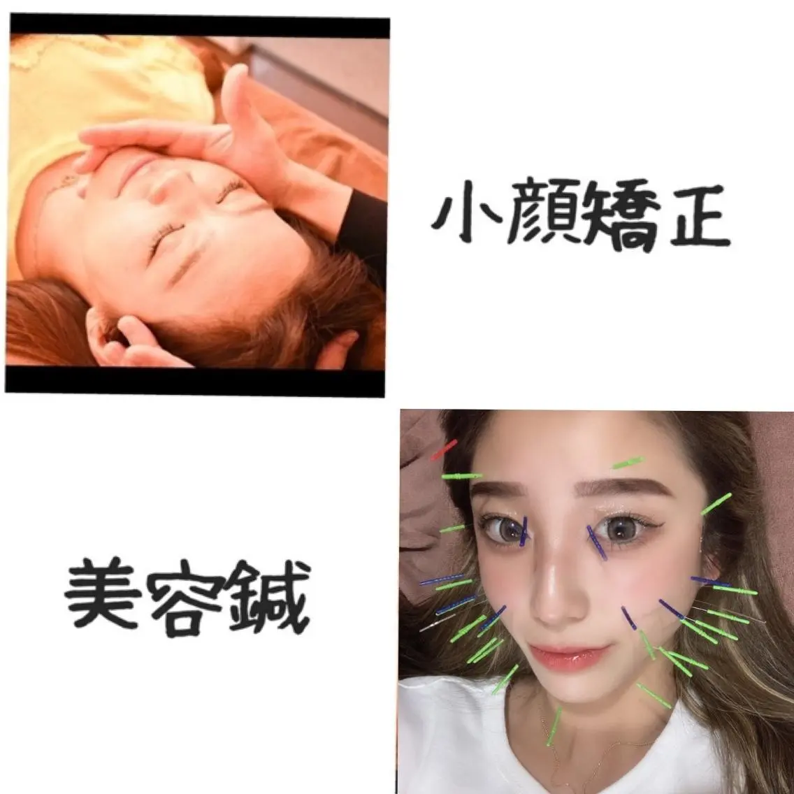 ❤️‍🔥人気No.1❤️‍🔥美容鍼 &小顔矯正&リンパマッサージの写真