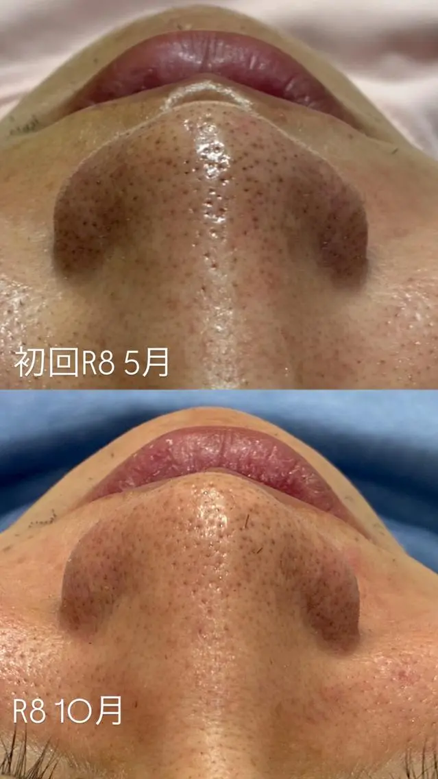 【当日予約1名限定】15分でツルスベ肌になれる毛穴洗浄✨の写真