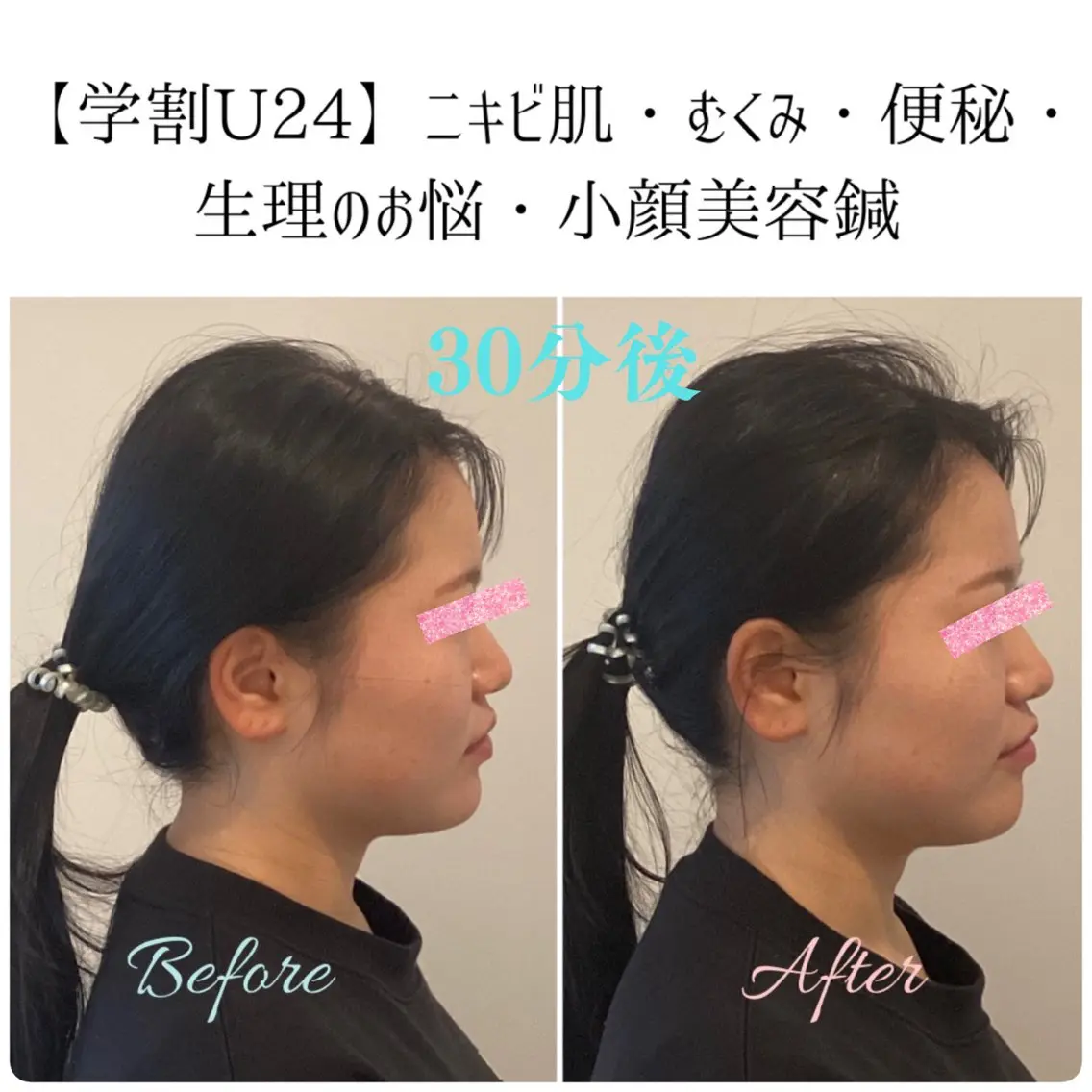 美容鍼&温活・免活 さくらんぼ鍼灸院のエステ・リラクイメージ