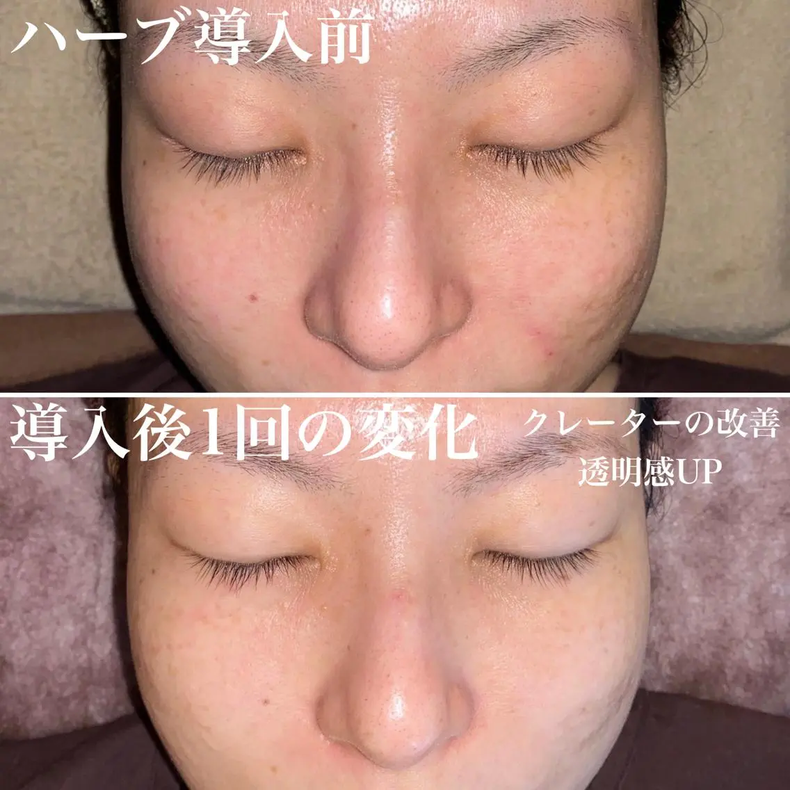 ロング カラー パーマ ヘアアレンジ メンズ キッズ ネイル マツエク・マツパ アイブロウ 透明感カラー 即小顔♥️美容鍼× ハーブピーリングのその他イメージ