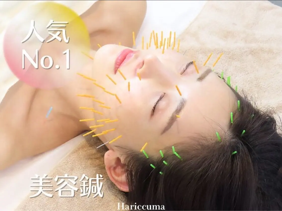【人気No.1小顔◎】 美容鍼 通常¥25000→¥12500の写真