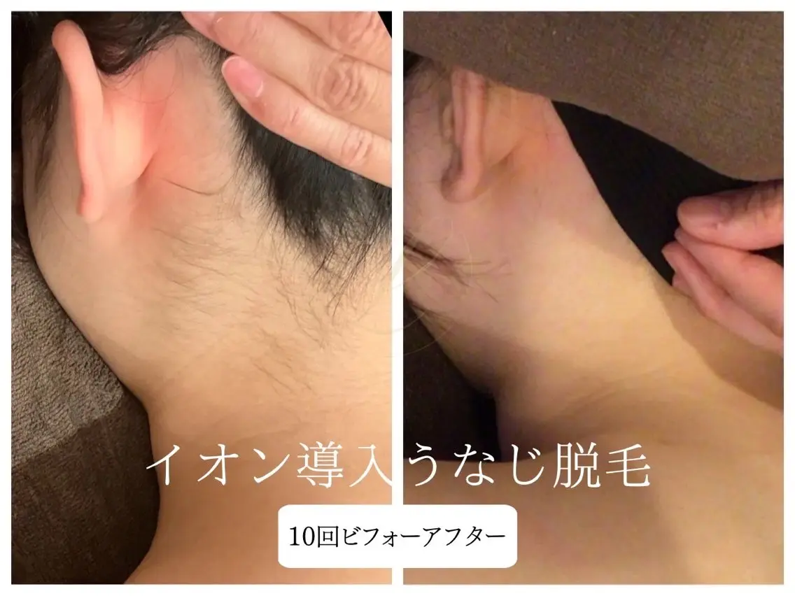 脱毛 🎀うなじ脱毛🎀 ㅣLino堀江のエステ・リラクイメージ