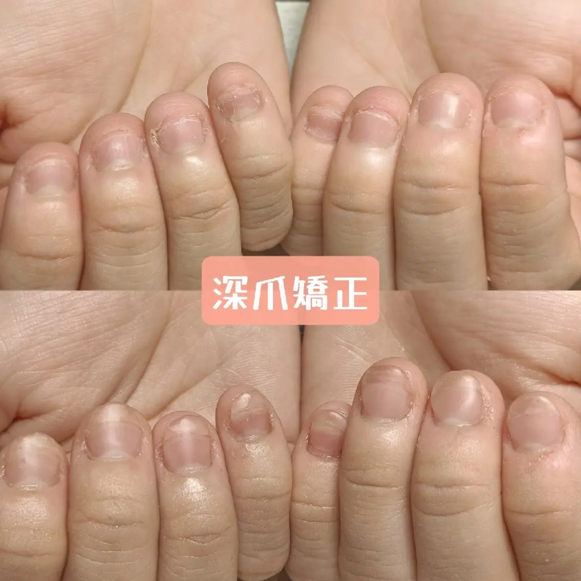 ネイル ハンドネイル ハンドケア 深爪矯正/爪育成ケア manie nailのネイルデザイン