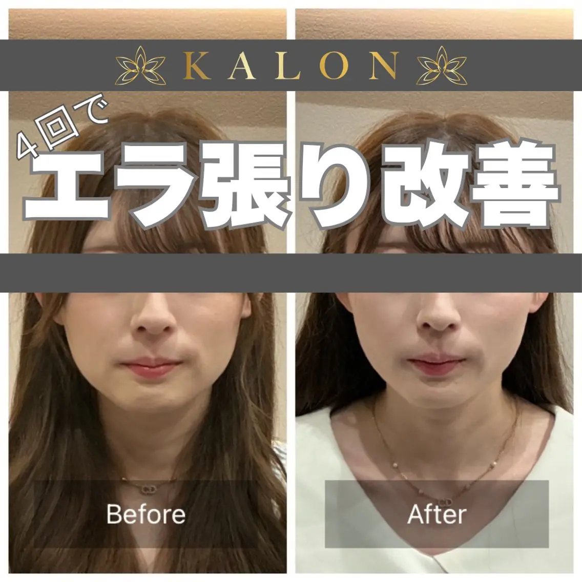 エステ リラク 美容鍼×整体 KALONのエステ・リラクイメージ