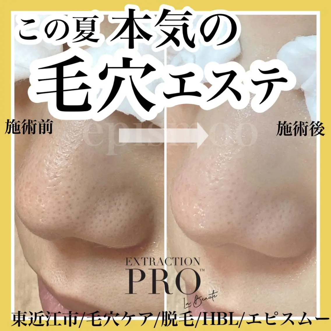 epismoo 脱毛/HBL/毛穴の眉毛・アイブロウイメージ