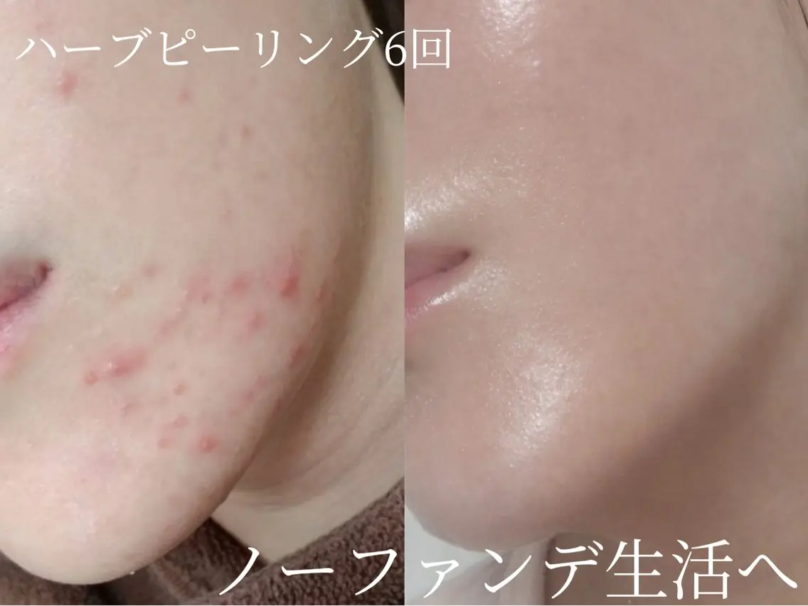 剥離無し🌿ハーブピーリング✖️幹細胞パックで肌質改善✨韓国陶肌へ【ミニモなら半額❤️🔥】の写真