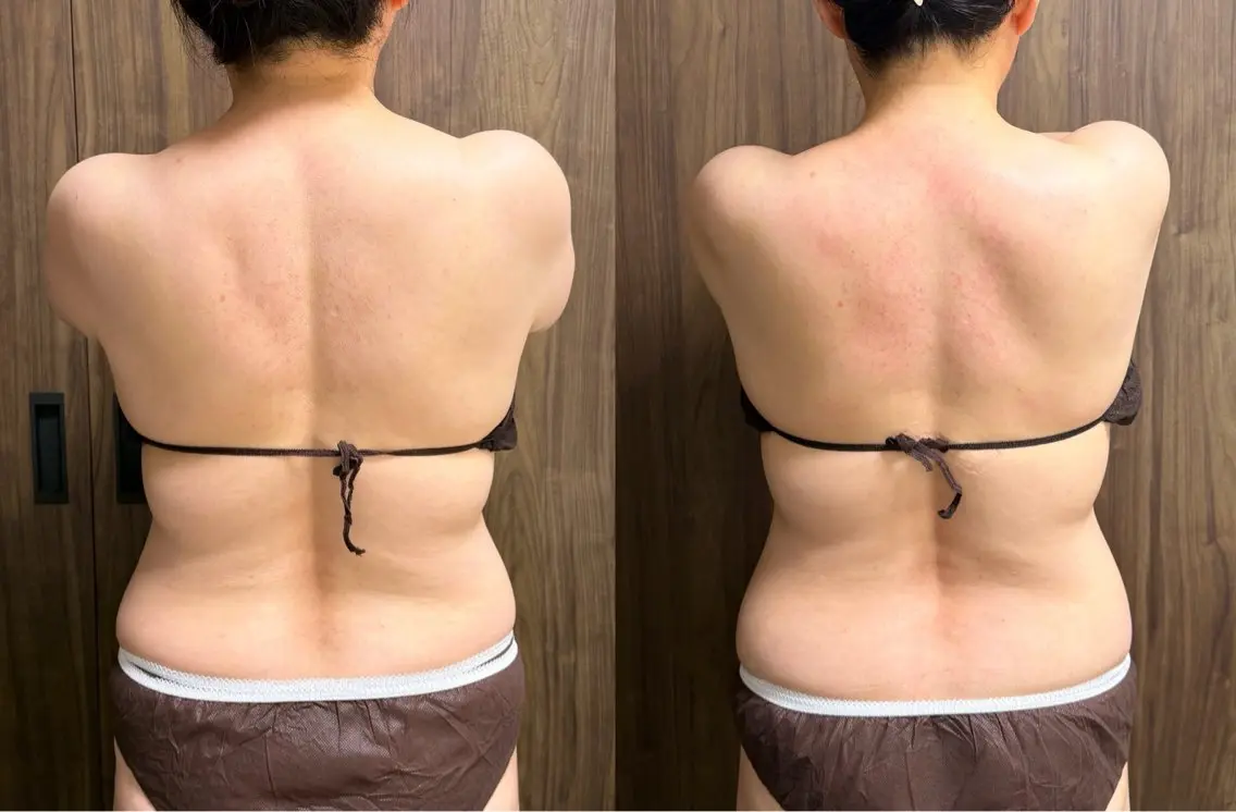 キャビゼロ+ハンドマッサージ 上半身(60分) 【背中・お腹・二の腕・デコルテ】の写真