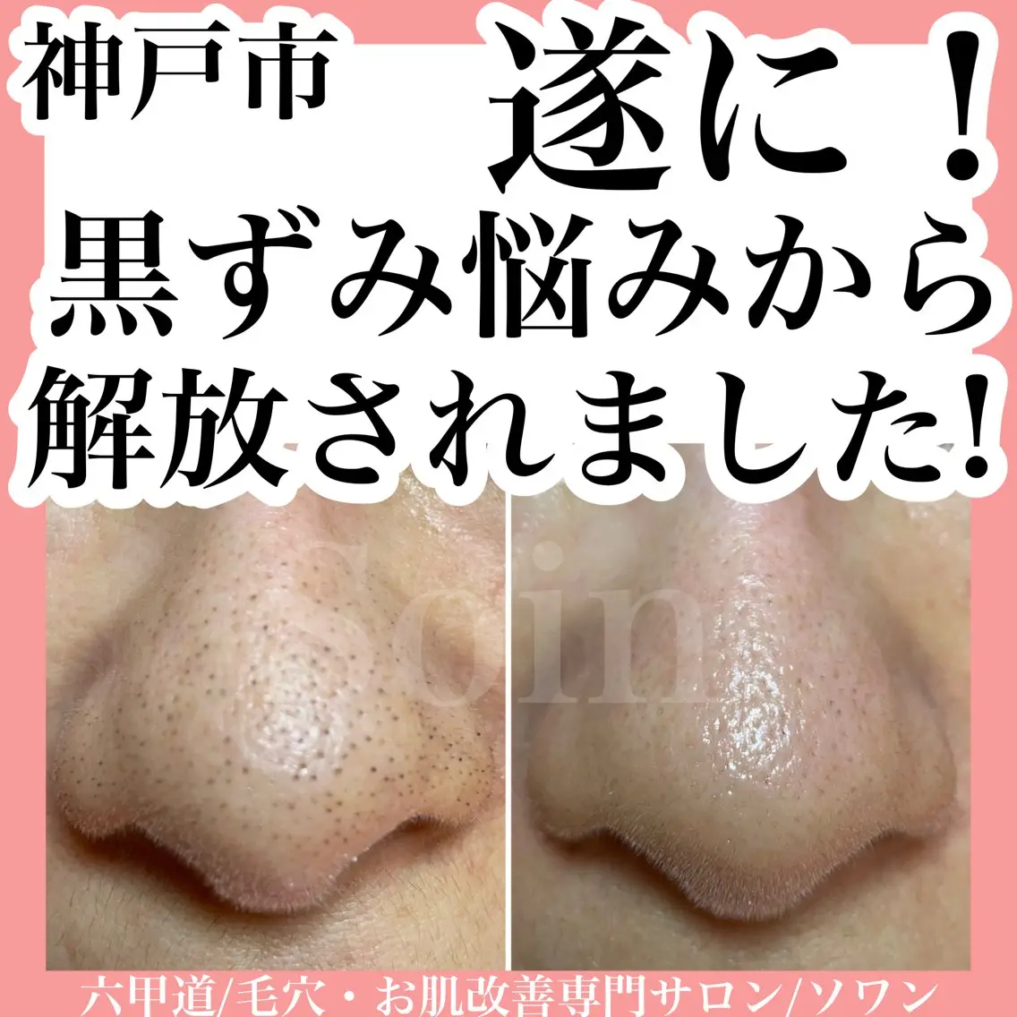 毛穴キレイコースの写真