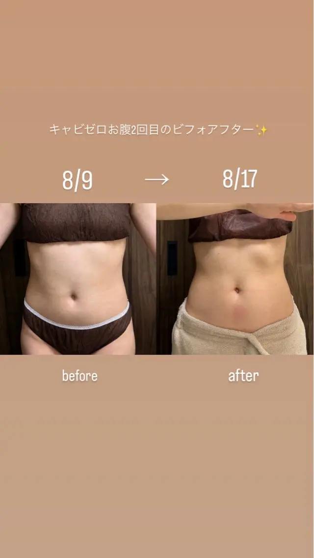 キャビゼロ+ハンドマッサージ 1部位(20分)の写真