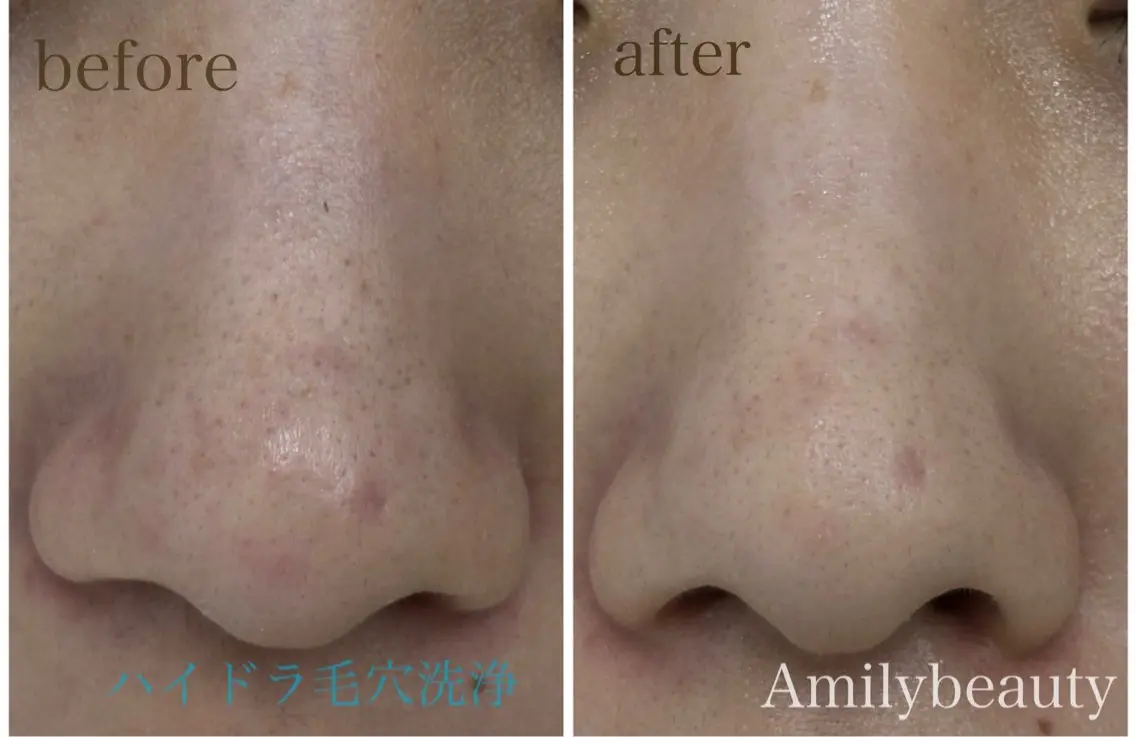 エステ Amily beauty 毛利のその他イメージ