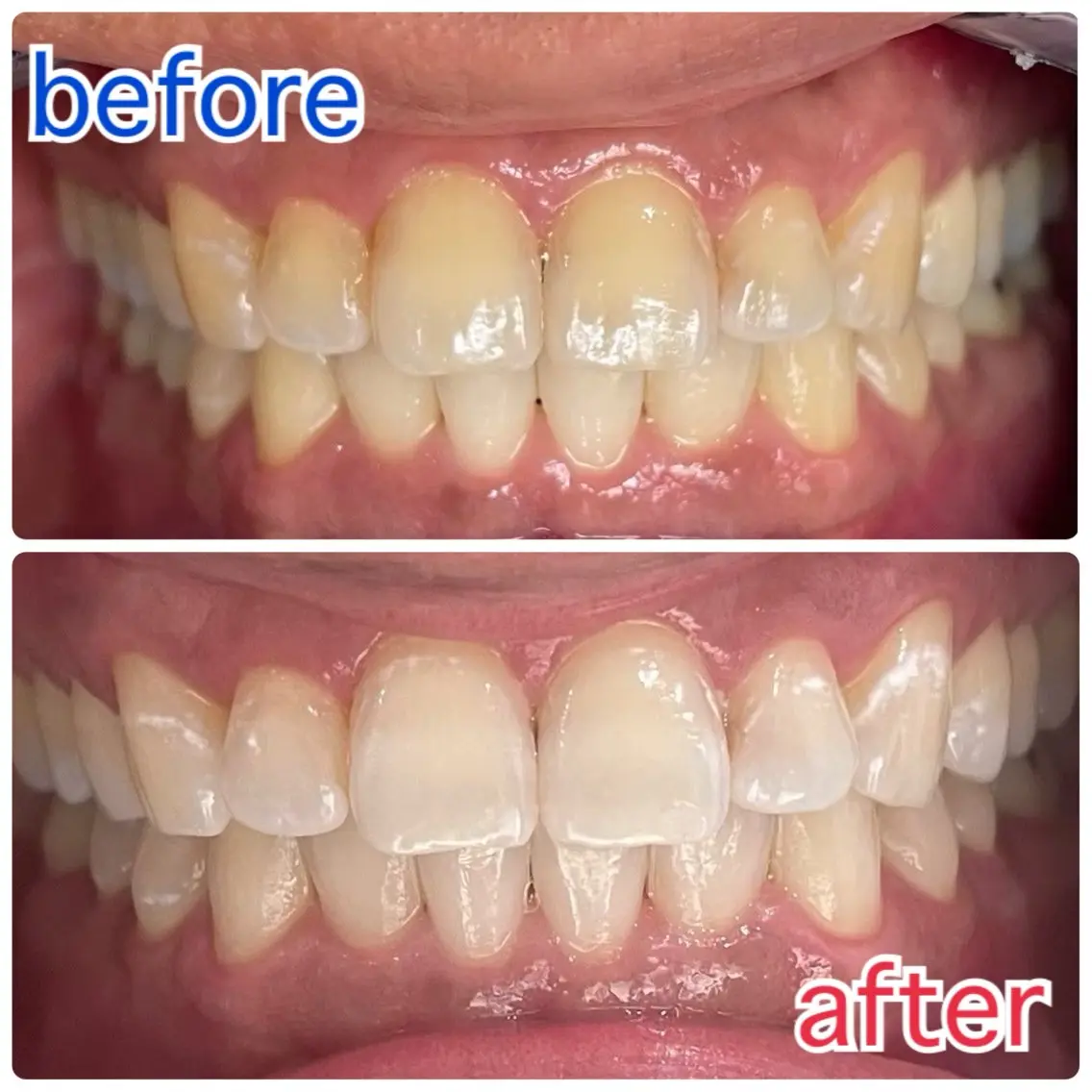 【期間限定👀】歯の黄ばみにホワイトニング体験メニュー🦷8分×2回で効果実感✨セルフで簡単本格ケア💎の写真
