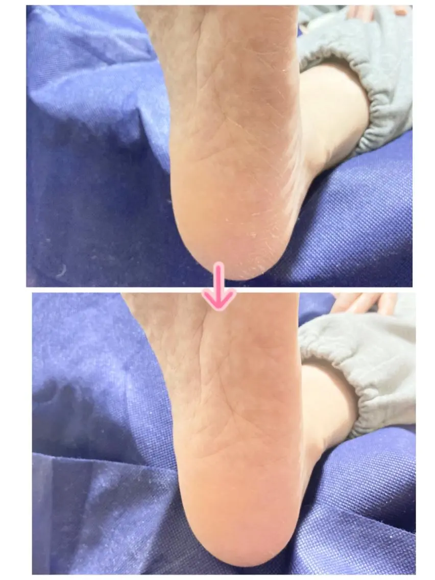 フット:かかとの角質除去25min(かかとの角質除去のみのメニューです)の写真