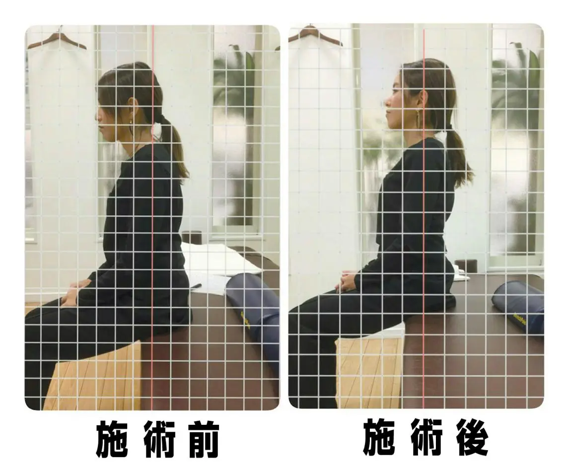 猫背矯正の写真
