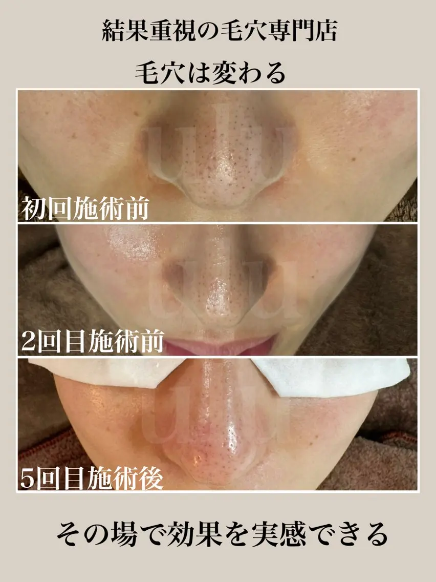 毛穴エクストラクションの写真