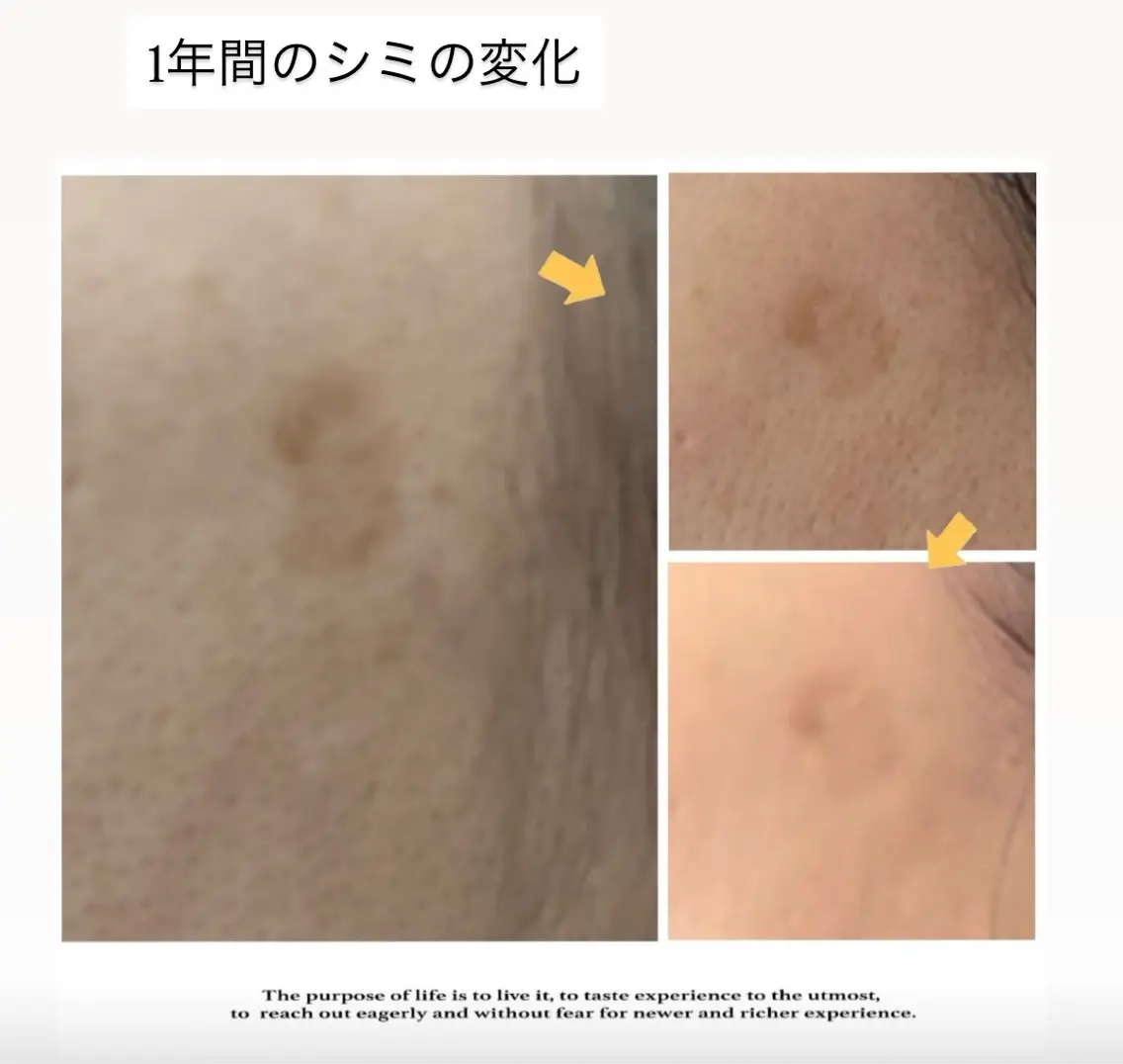 シミにお悩みの方✨徹底美白コース✨¥9,900→¥6,600 イオン導入➕パックの写真