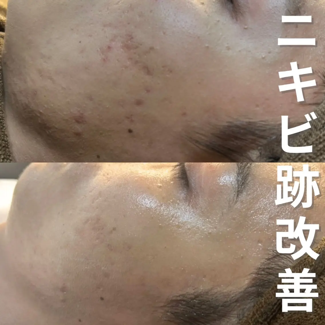 エステ ニキビ・ニキビ跡改善 leoloのエステ・リラクイメージ