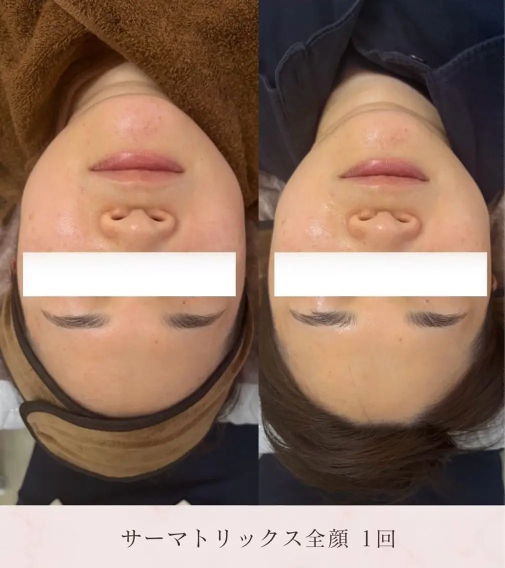 【五月限定】サーマトリックス全顔➕首💆♀️LHA洗顔付🫧ハリ感やフェイスライン整えませんか 看護師施術の写真