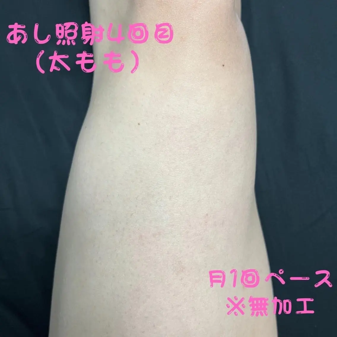 メンズ キッズ 脱毛 メンズ脱毛フェリッセ /男女🆗キッズ🆗のエステ・リラクイメージ