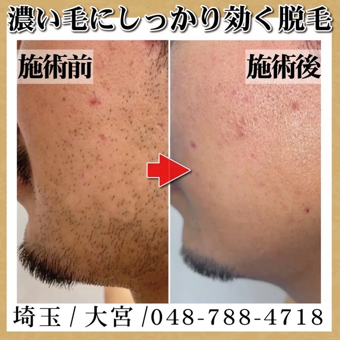 脱毛 脱毛 TOWA大宮のエステ・リラクイメージ