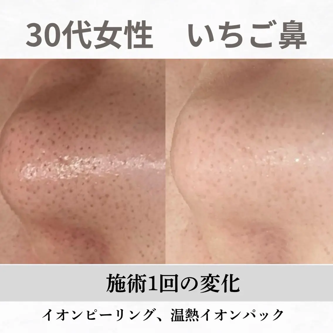 重度ニキビ専門🌷 ダウンタイムなしのエステ・リラクイメージ