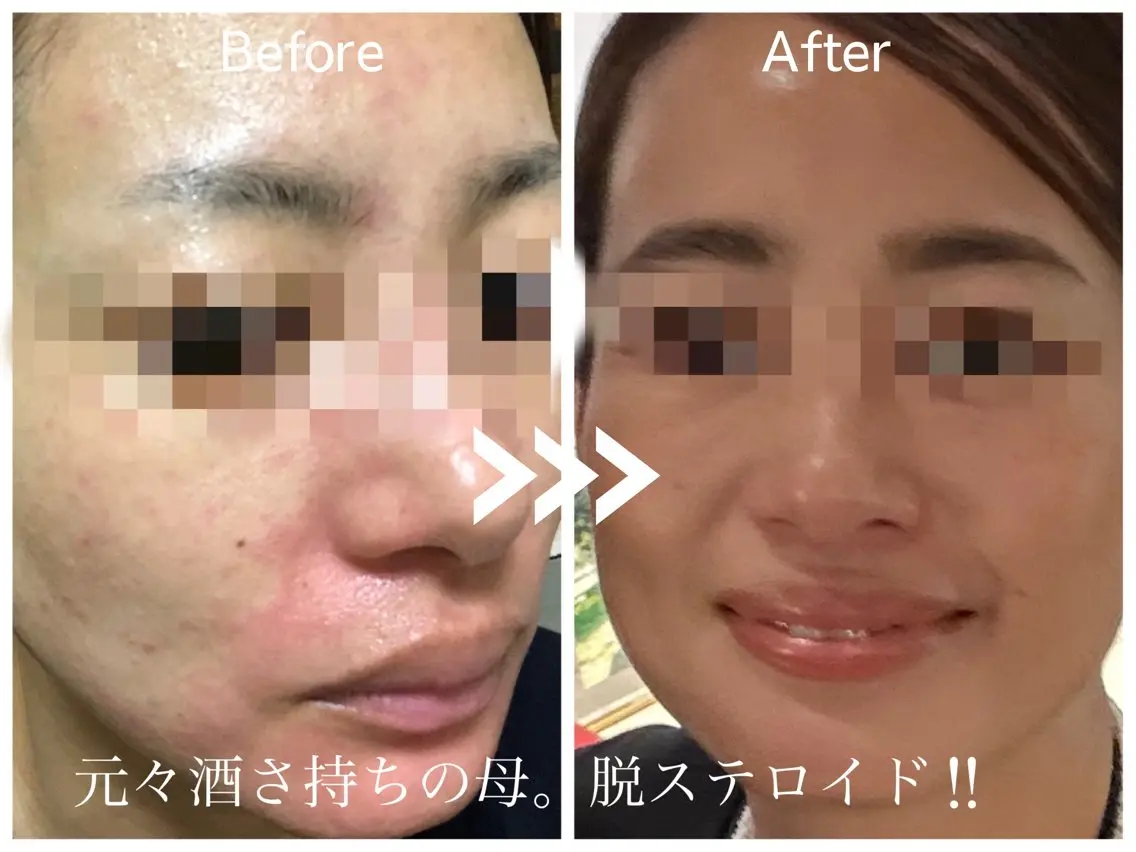 毛穴開き黒ずみ ニキビ特化💆‍♀️のエステ・リラクイメージ