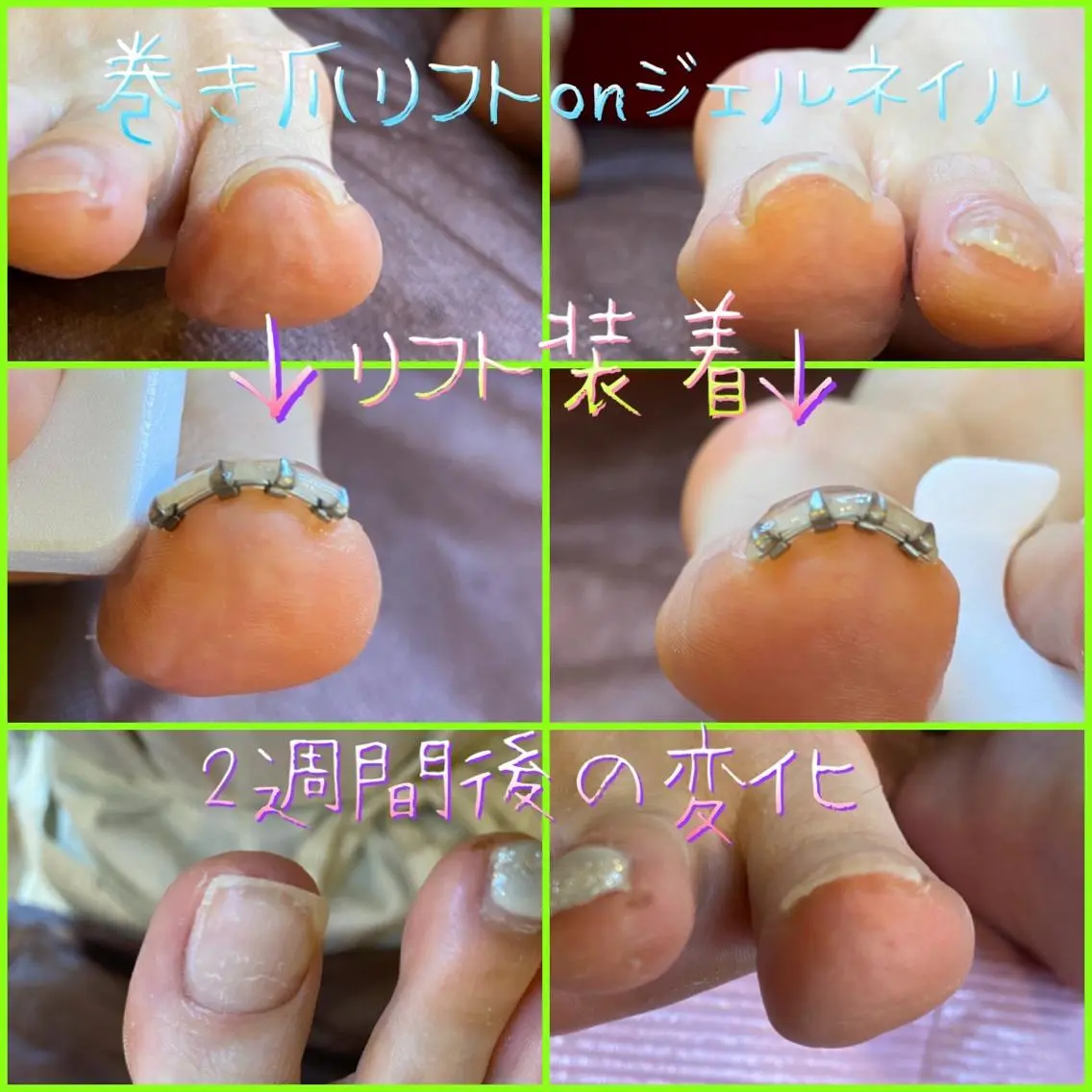 ネイル フットネイル 持ち込み 夏ネイル ♢ME2ROOM♢ #巻き爪#リラクのネイルデザイン