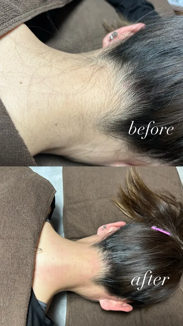 うなじWax＋うなじ光脱毛🍃の写真