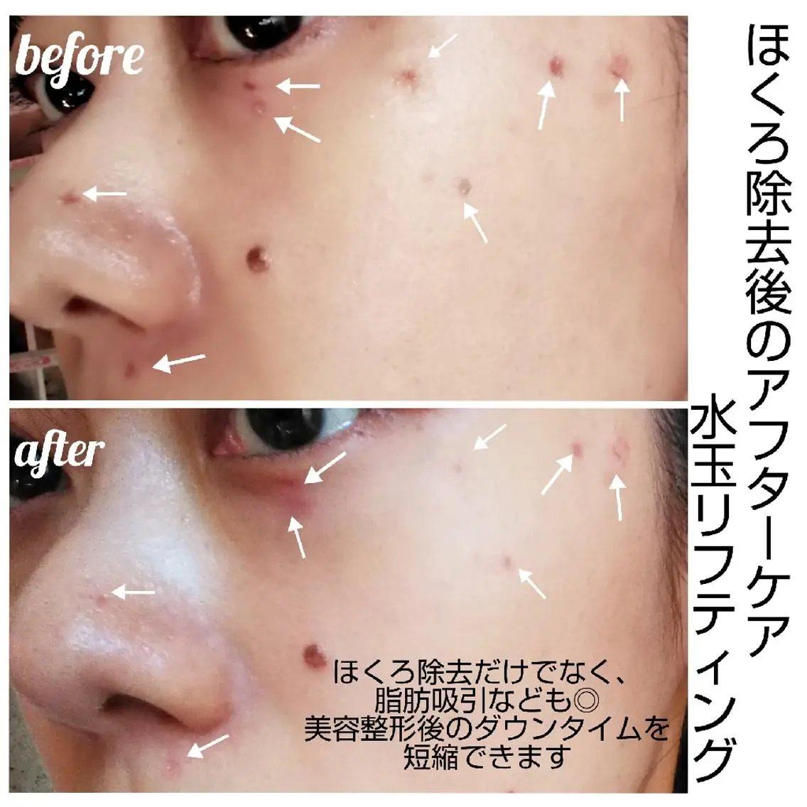 ニキビ•ニキビ跡改善 salon varyのエステ・リラクイメージ