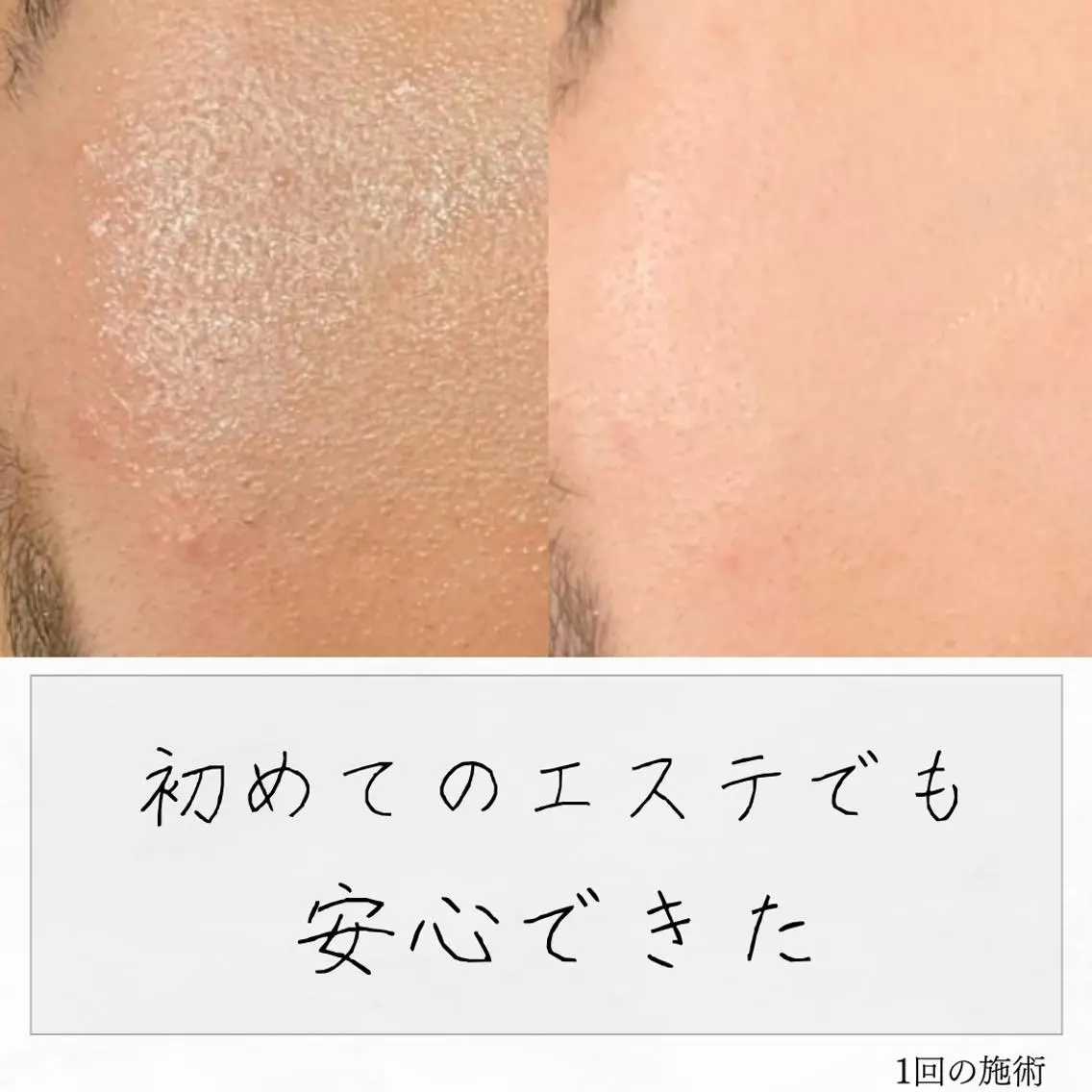 ニキビ経験者が施術 する専門サロン🌻のエステ・リラクイメージ