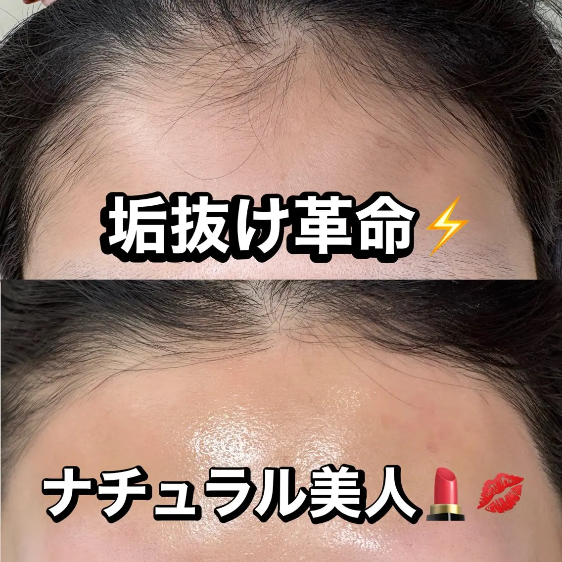 【眉×おでこ】１番人気❤️‍🔥眉毛デザイン×おでこワックス❤️‍🔥眉毛も！おでこも！の写真
