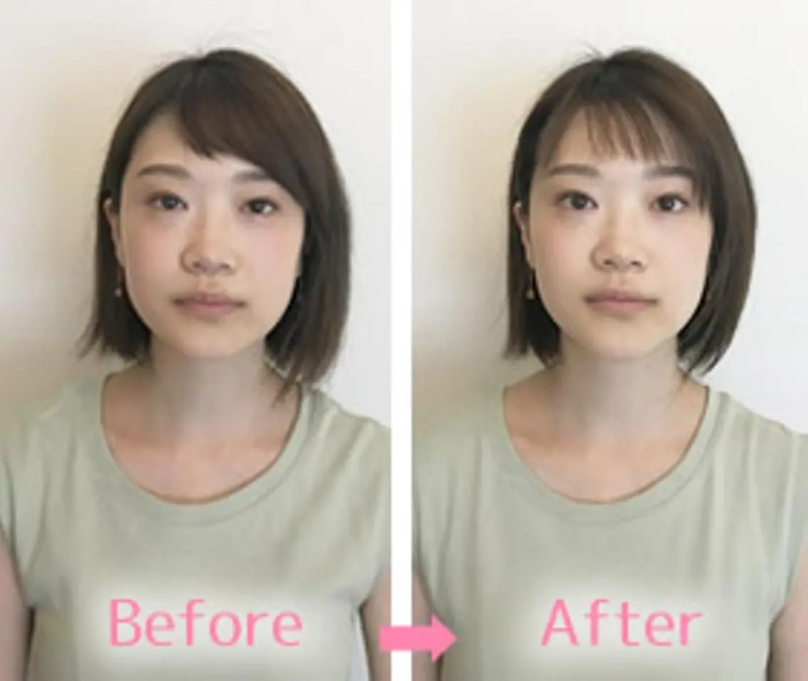 【たるみ・むくみ解消】痛くない小顔矯正✨リフトアップ実感の写真