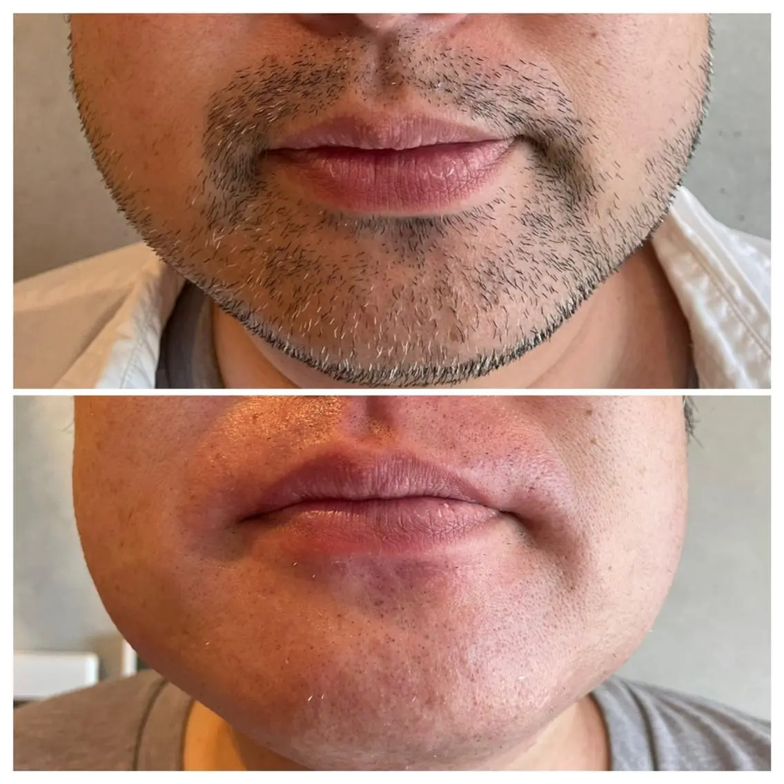 メンズWax脱毛ヒゲ全体の写真