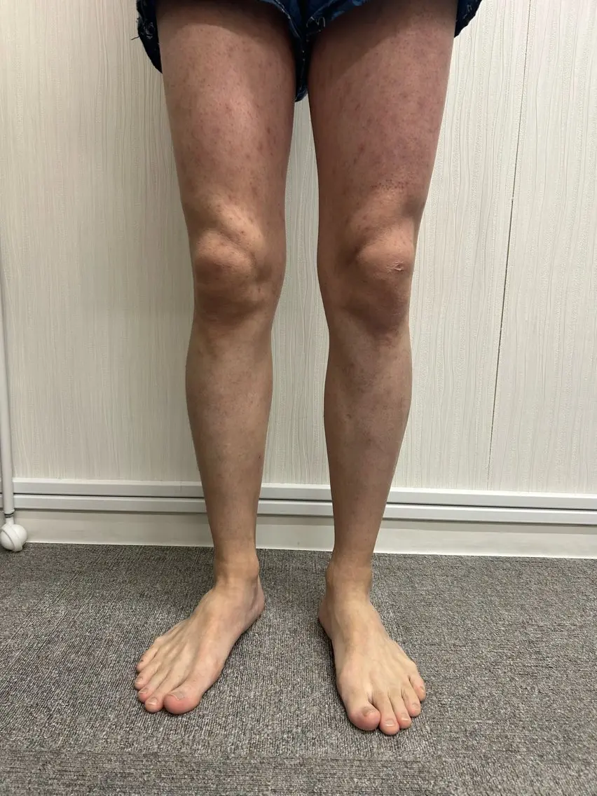 男性足まるごと脱毛メンズの写真