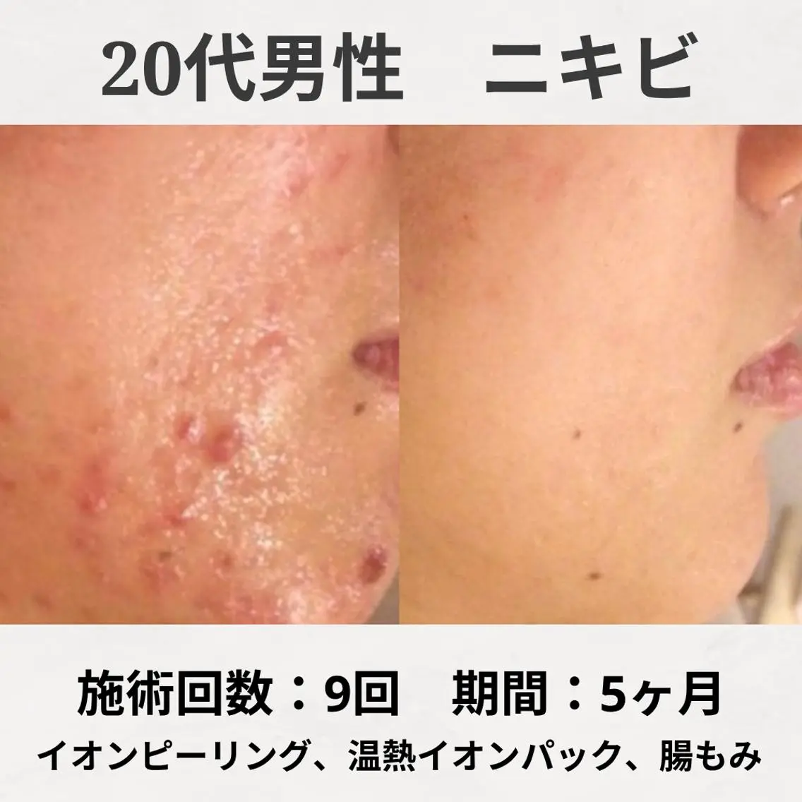 エステ リラク 繰り返すニキビ跡専門 根本改善のエステ・リラクイメージ