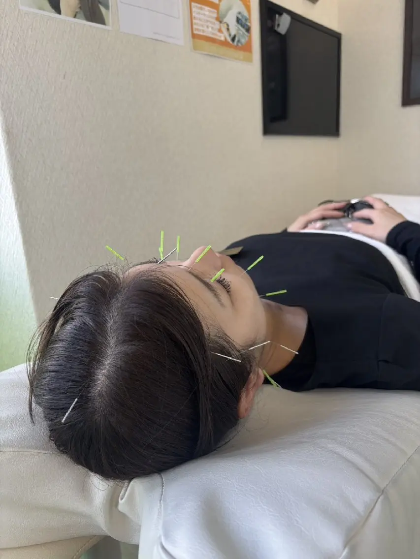 🍀美容鍼+体質改善 10名様限定🌟口コミ割の写真