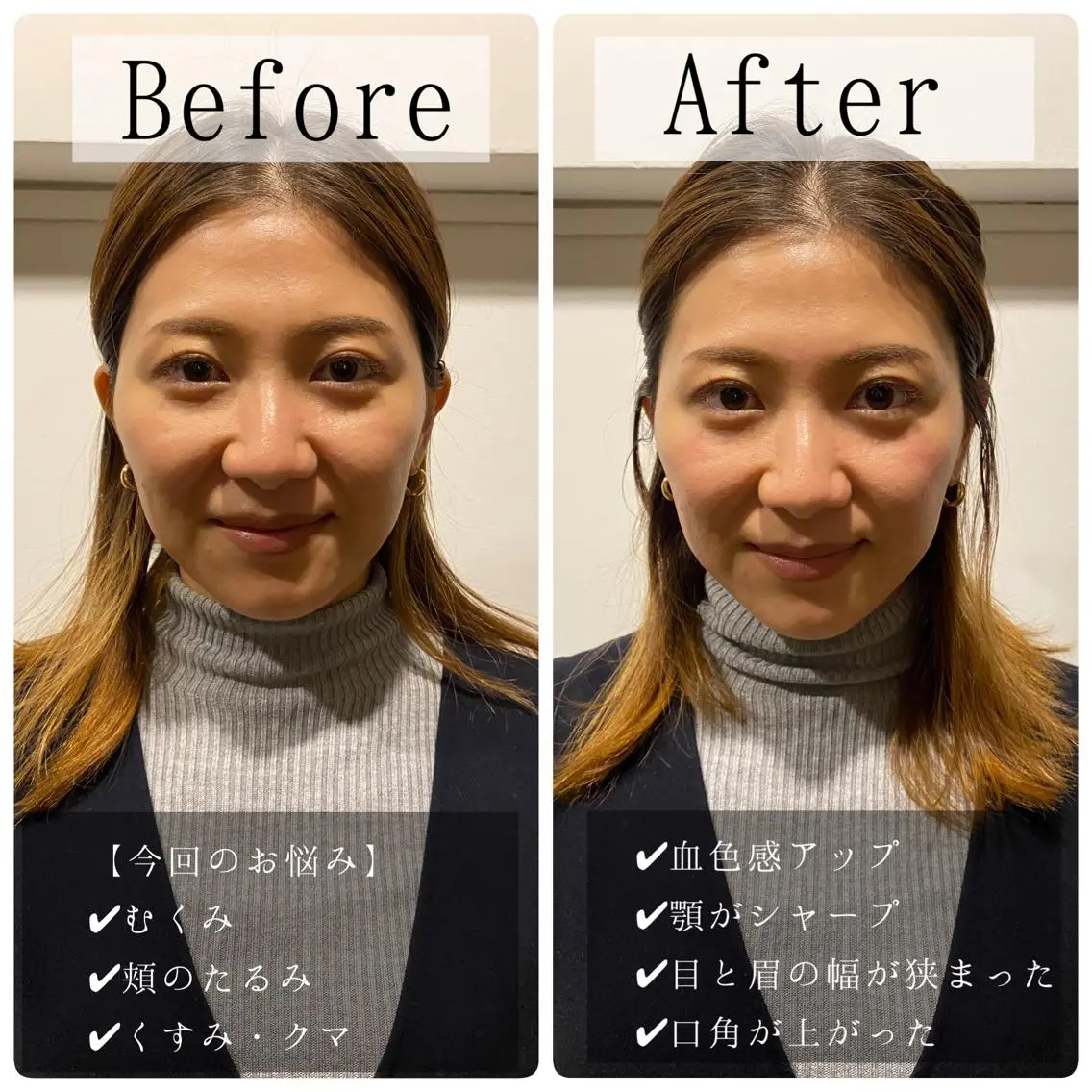 肌質改善美容鍼 ×ハーブピーリングのエステ・リラクイメージ