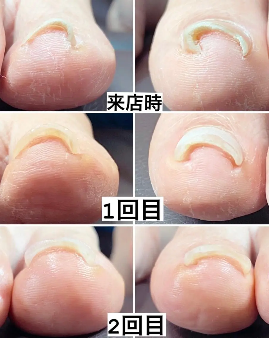 痛くない　巻き爪ケア　1ヶ所6600     1本11000の写真