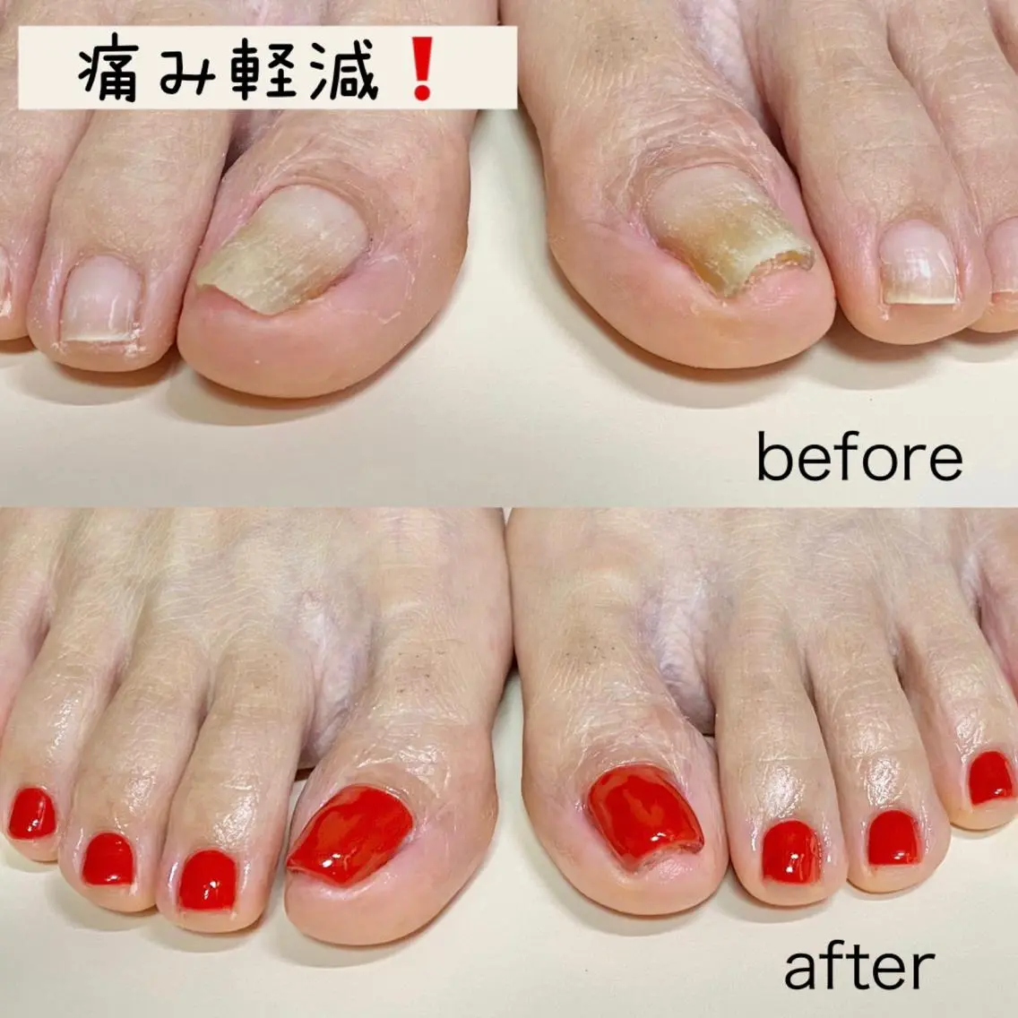 巻き爪補正✨親指2本＋ワンカラー👣オフ有の写真
