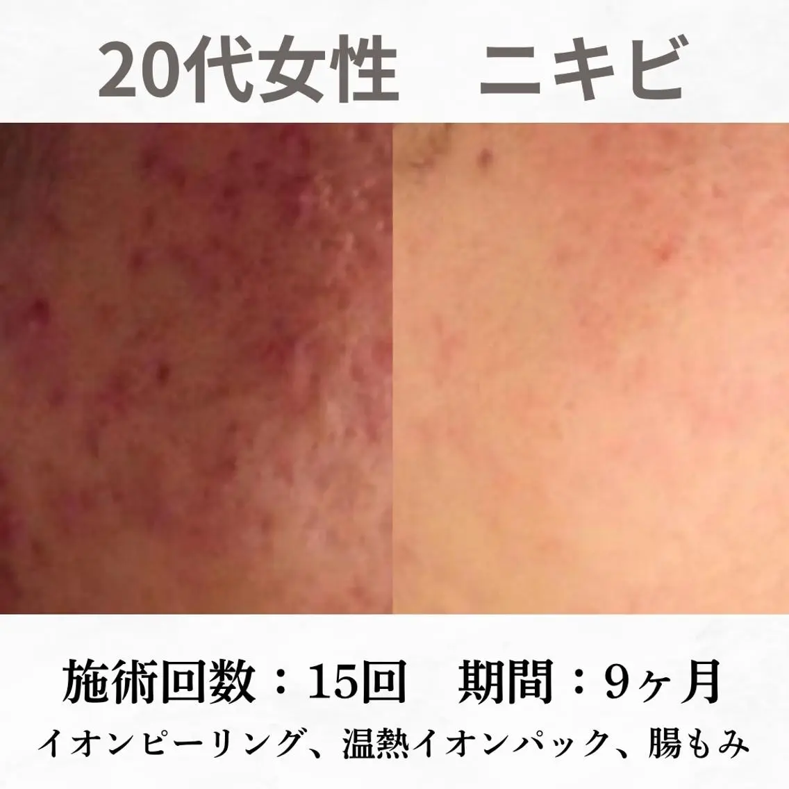 重度ニキビ専門🌷 ダウンタイムなしのエステ・リラクイメージ