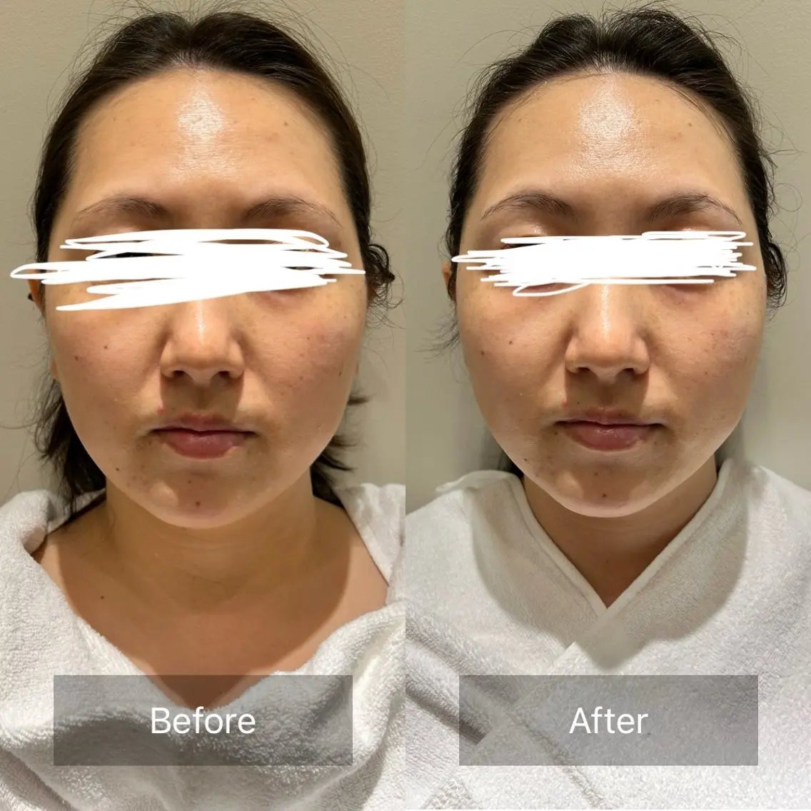 💆‍♀️フェイシャル💆‍♀️カーボキシー炭酸パック/３Step工程💕の写真